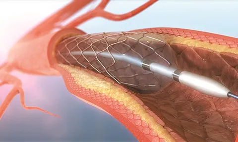 Việt Nam lần đầu tiên sản xuất thành công Stent phủ thuốc và bóng nong mạch hỗ trợ điều trị các bệnh tim mạch